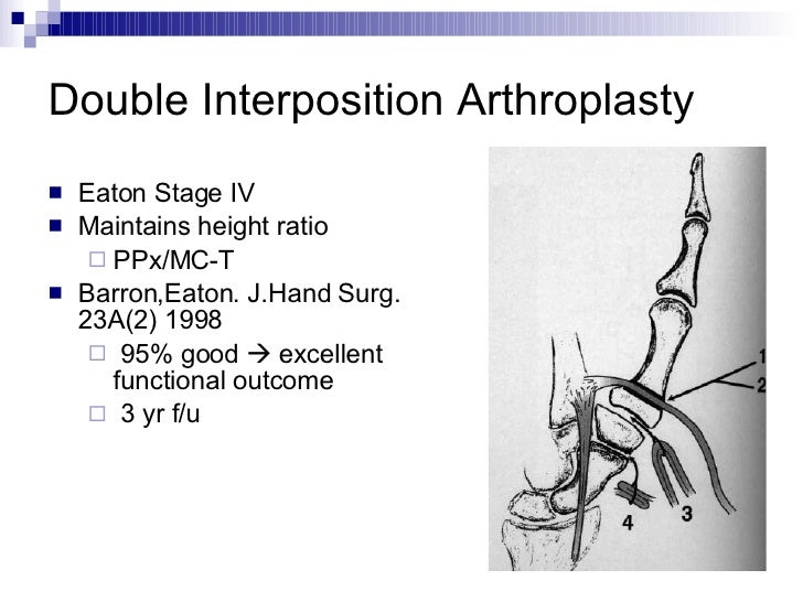 interpositional arthroplasty on thumb joint Interpositional arthroplasty on thumb joint